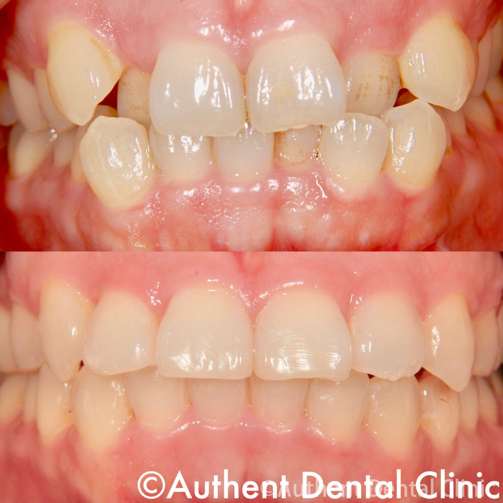抜かない八重歯の治療 全体矯正 医療法人オーセント歯科クリニック